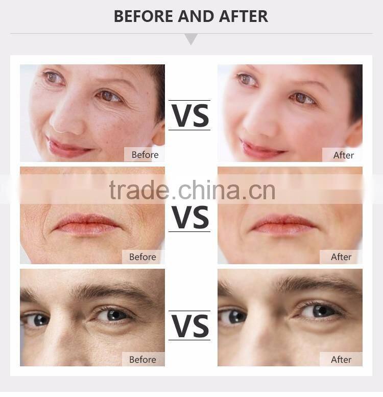 radio frequency scanner usb skin tightening face and cellulite