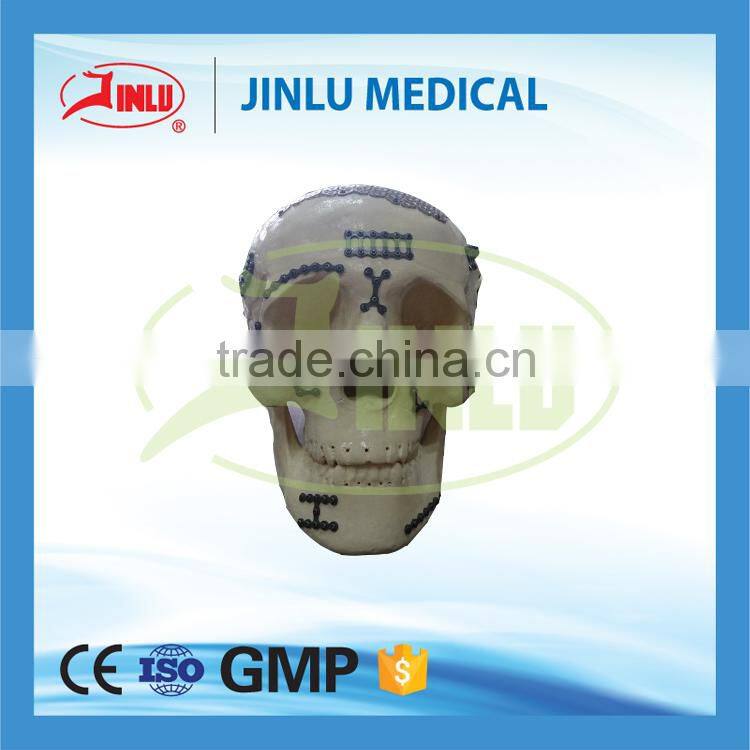 Maxillofacial plate, face mini plate, titanium plate