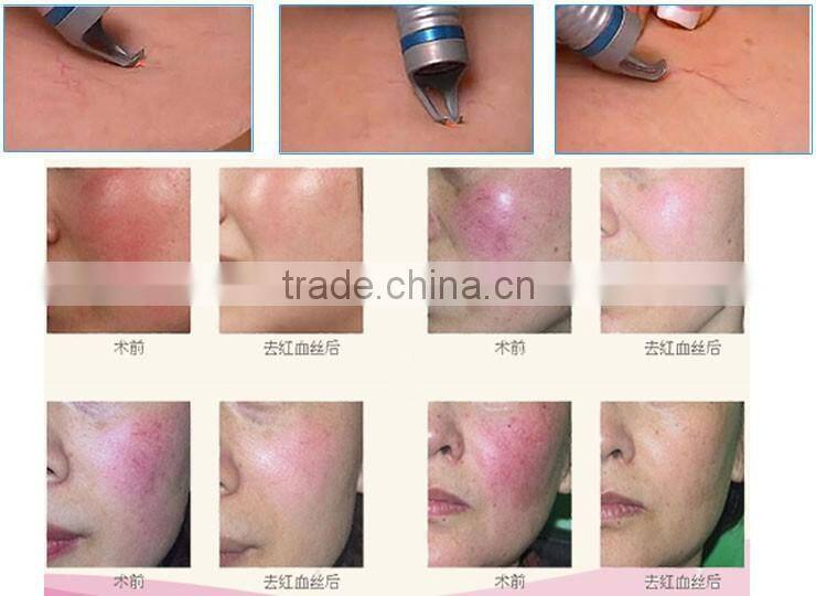 Alibaba sell 980nm diode laser Vascular Removal, Diode Laser Vascular Spider Vein Removal Machine