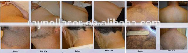 Big Spot Size 16mm*50mm HR+SR+VR IPL Machine for Wrinkle Removal