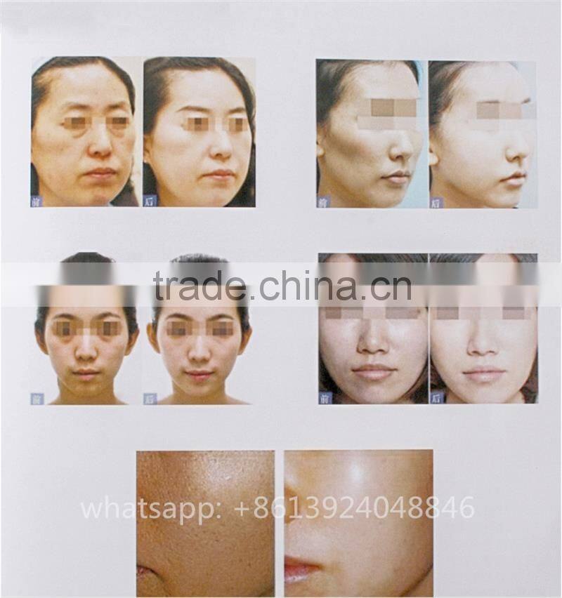 mesotherapy needless meso gun no needle mesotherapy machine anti aging facial skin rejuvenation