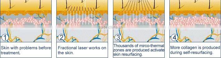 Christmas biggest discount!New Fractional CO2 Laser for Wrinkle Removal Skin Resurfacing equipment