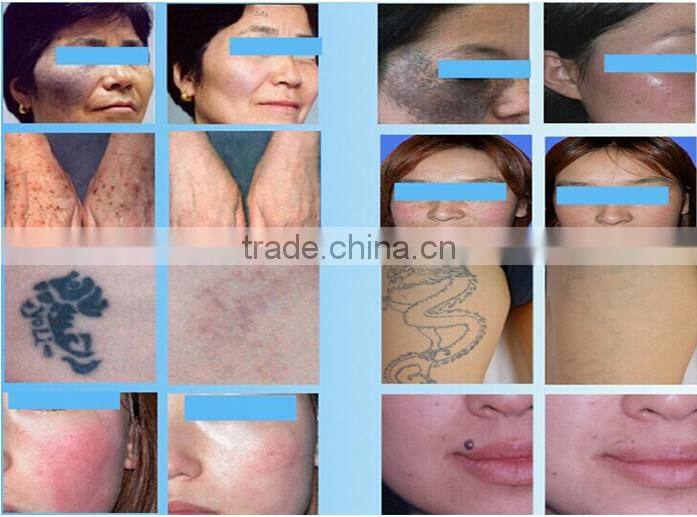 Factory price!!!q-switch nd yag laser tattoo removal pigment removal whitening medical machine