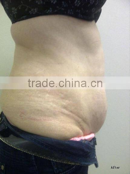 Cavitation RF Tripolar Ultrasonic Fat Removal Machine F019