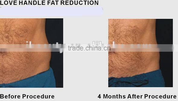 Cryotherapy fat freezing Cryotherapy equipment Cryotherapy machine for sale