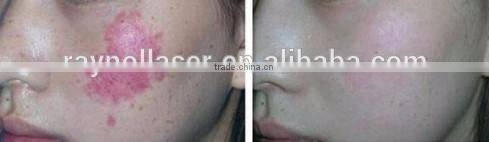 Import Laser Generator 755nm Alexandrite Laser Machines