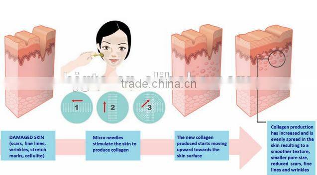 540 needles 1.0mm microneedle derma skin rollers dermaroller