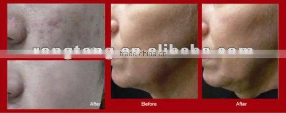 facial rejuvenation oxygen beauty machine equipment