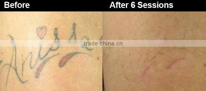 Professional Q-switch ND YAG Laser