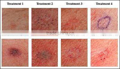 Beauty equipment tattoo removal machine multifunction Q Switched Nd Yag Laser device