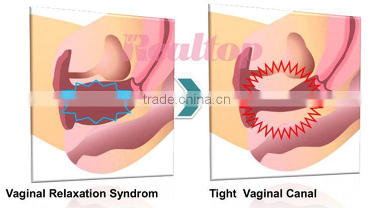 2016 Most popular made in China co2 laser fractional vaginal tightening device