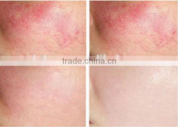 Beijing new product 30W diode laser 980nm vascular vein stopper spider vein / laser vascular removal machine / laser for face