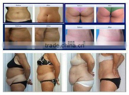 Home salon use ipl+elight+vacuum+rf+cavitation + lipolysis cosmetology machine