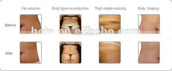 Guangzhou HETA Cavitation RF radio frequency cellulite reduction beauty machine