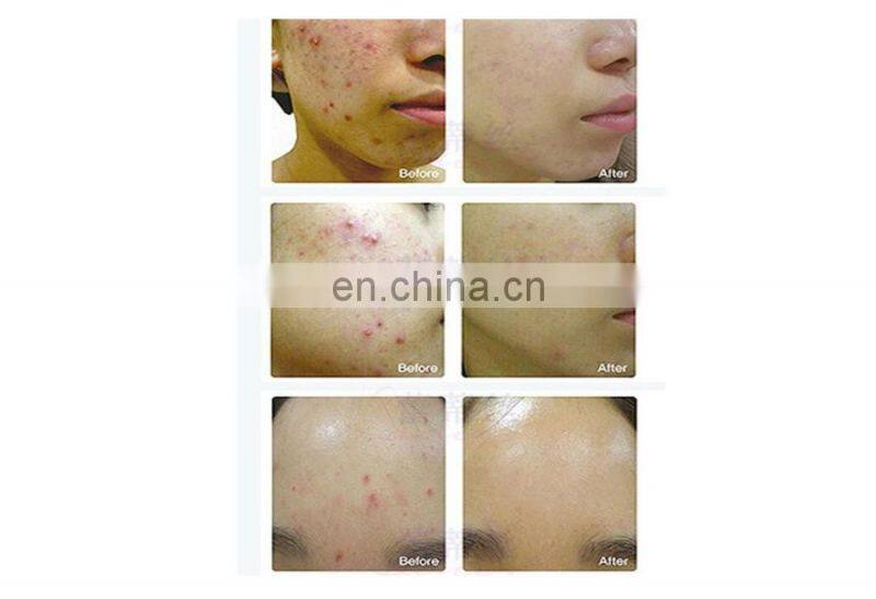 2022 hot sale Acne removal Skin Rejuvenation led light therapy pdt photodynamic Dynamical Therapy LED Photon Whitening