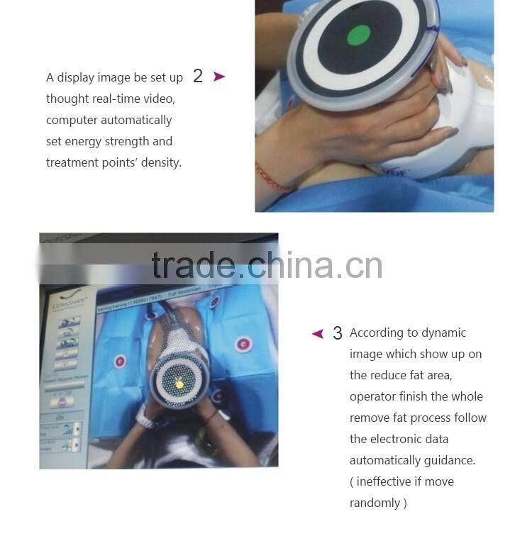 2016 ultrashape hifu body slimming machine / liposonic machine / ultrasonic ultrasound liposuction equipment for weight loss