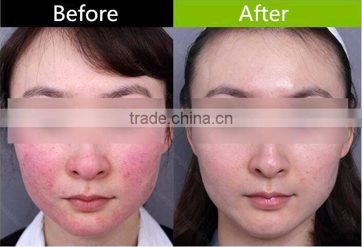 Blood vessels removal/ spider veins removal machine with low price