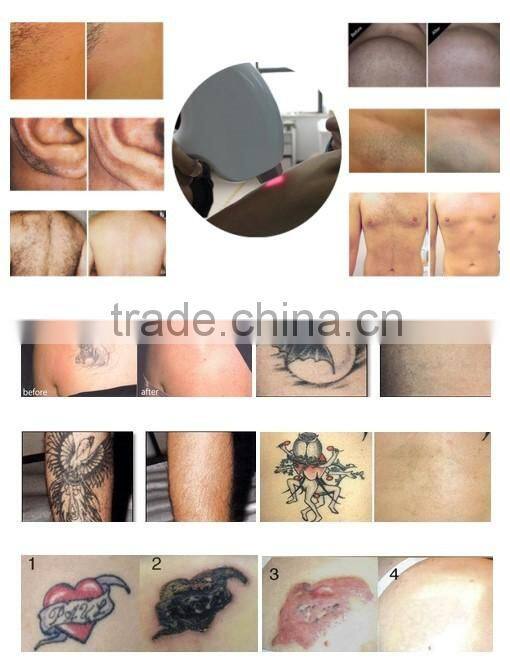 Double handles Elight IPL yag laser machine for hair removal and tattoo removal
