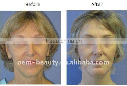 20% discount portable ipl equipment for hair removal with medical ce