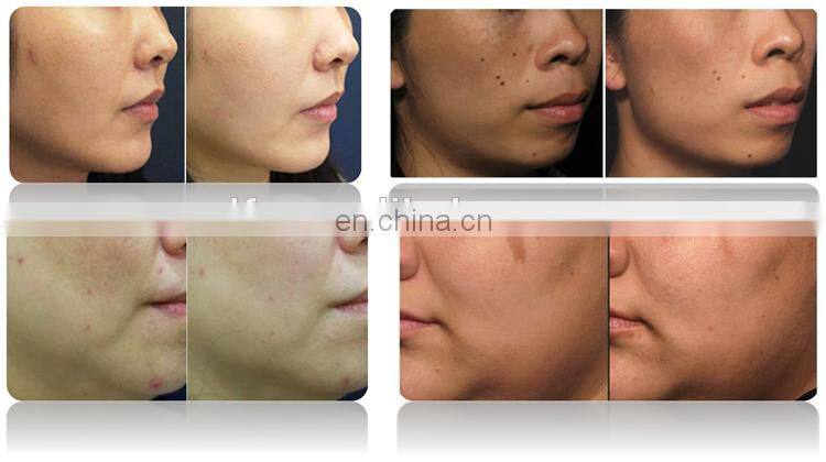 Switch ND YAG Laser price/tatto removal machine/ q swithed laser