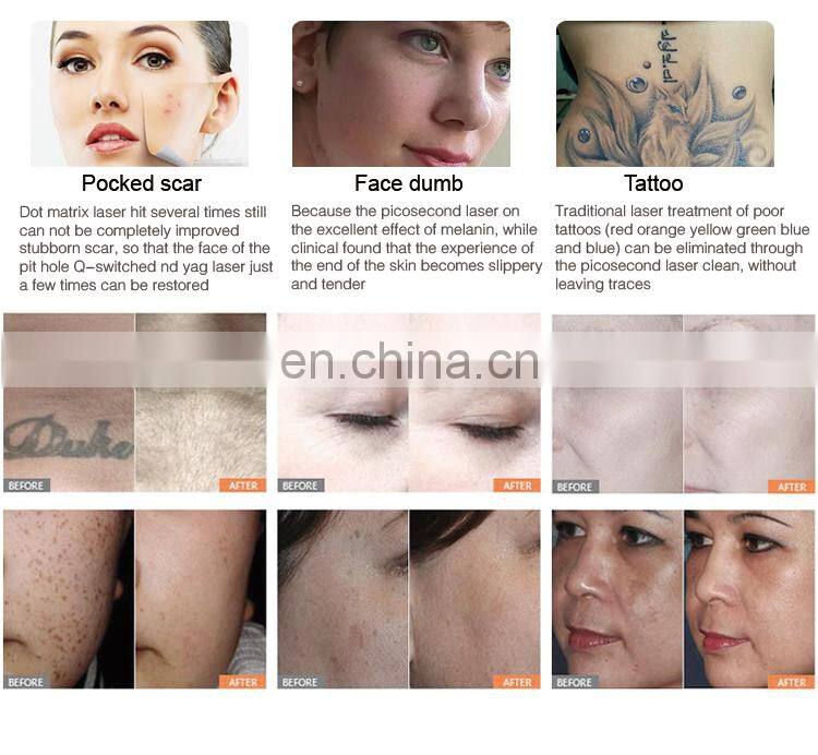 NEW Laser Picosecond for Tattoo Removal q switch pico laser 1064nm 532nm 755nm tattoo removal device