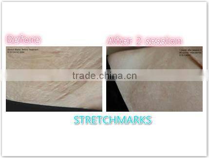 fast beauty device!!!CDT CO2 carboxy equipment/carboxy therapy machine