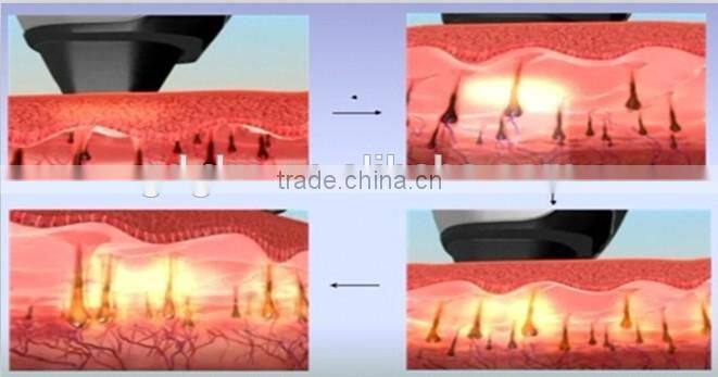 E-001 IPL hair removal machine/ IPL Machine