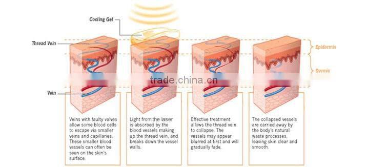OD-H980 Portable 980nm laser spider vein removal