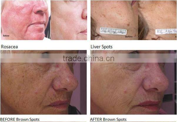 big spot size fast hair removal ipl beauty equipment for sale