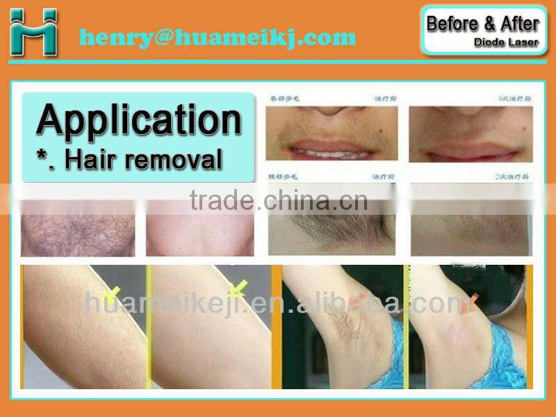 808nm Diode Laser system for hair removal