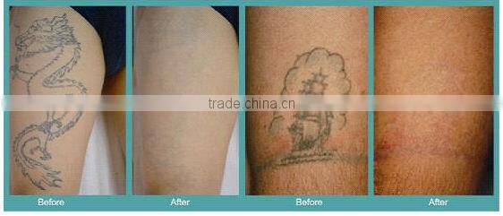 2016 best professional laser tattoo removal machine AL1