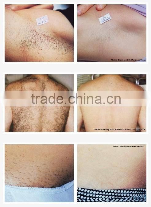 professional diode laser / portable laser facial body hair removal machine
