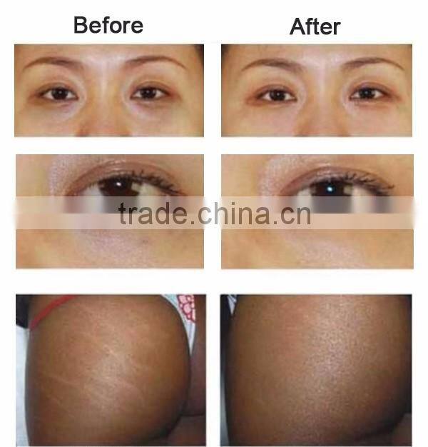 CO2 Carboxytherapy Machine , carboxy therapy machine ,carboxtherapy equipment VM102