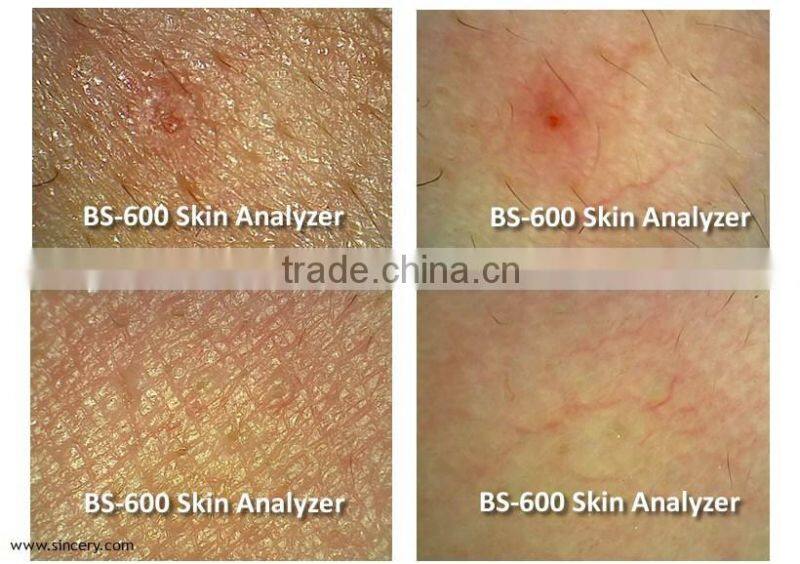 Home, salons and clinics using portable skin tightening skin analyzer