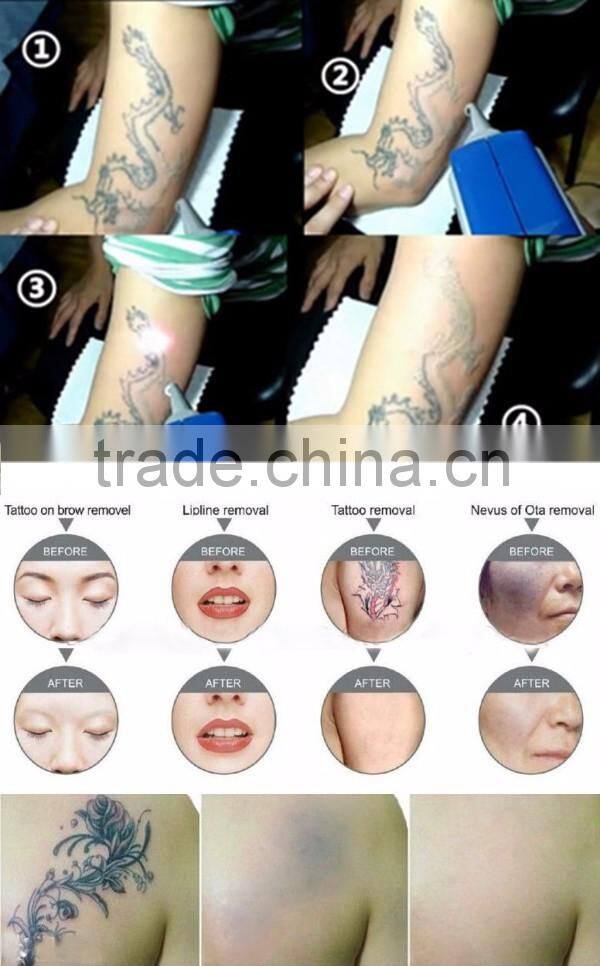 Hair removal nd yag long pulse laser