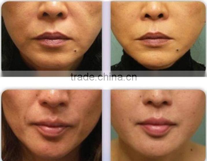 best rf skin tightening face lifting machine, fractional rf microneedle