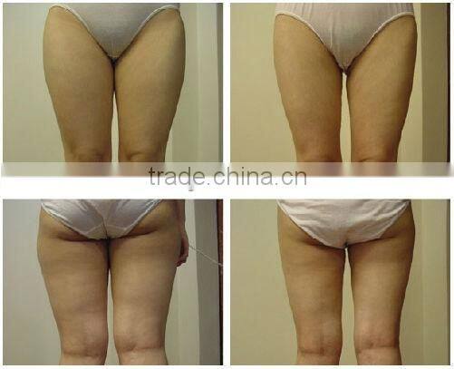 Ultrasonic Cavitation & rf slimming machine for beauty salon - F017