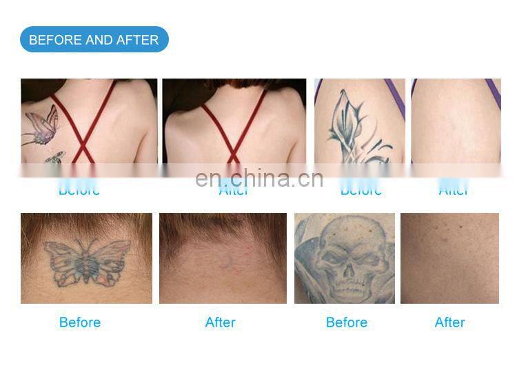 tattoo removal laser machine china laser/price laser tattoo removal