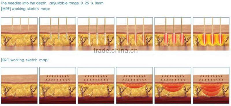 best selling stretch marks removal mini rf / rf beauty machine / rf lifting