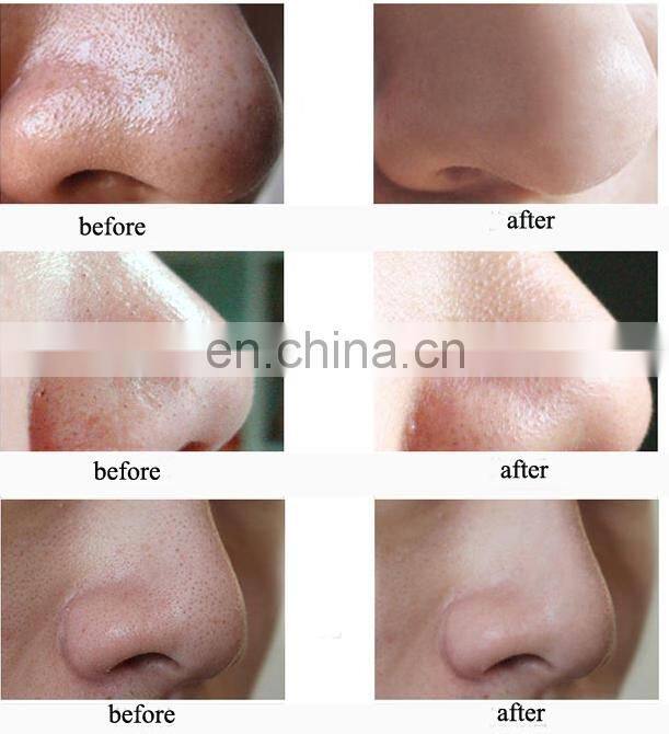2019 Hot Sale Acne Pimples Removing Blackhead Extractor With Water Round