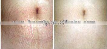 High cost-effective shrink pores mym electric dermo pen EL011