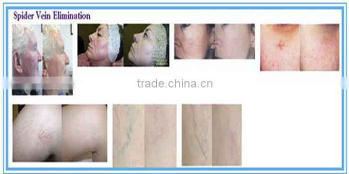 best prices long quality warranty 1064nm long pulse nd yag laser hair removal machine