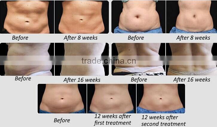 BZ05-Zilia Ultrasonic Vacuum RF Cavitation fat reduction machine