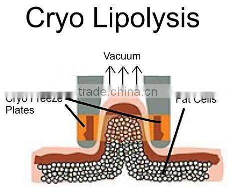 home use cryolipolysis machine for fat removal cryo machine