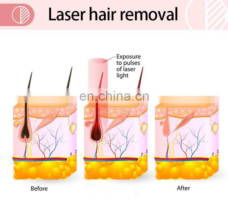 High-grade Diode Laser System Epilation 808nm Diode Laser Hair Removal Laser Machine For Sale