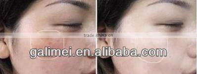 Home use Auto Micro Needle Device with CE