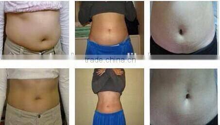 lipo laser/Winkonlaser lipo laser/double wavelengths lipo laser