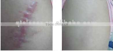 QTS-Laser Korea 7 joints articulated arm tattoo removal machine yag laser q switch