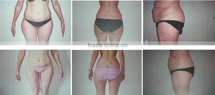 distributors wanted vacuum & cavitation & rf made in China