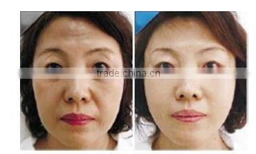 fractional RF beauty equipment for skin lifting wrinkle removal